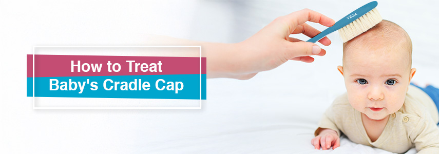 How to Treat  Baby’s Cradle Cap at Home?